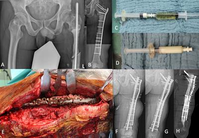 Case report: Local bacteriophage therapy for fracture-related infection with polymicrobial multi-resistant bacteria: hydrogel application and postoperative phage analysis through metagenomic sequencing
